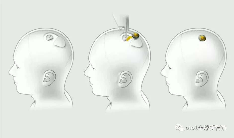 脑机手术-模拟人体实验效果图